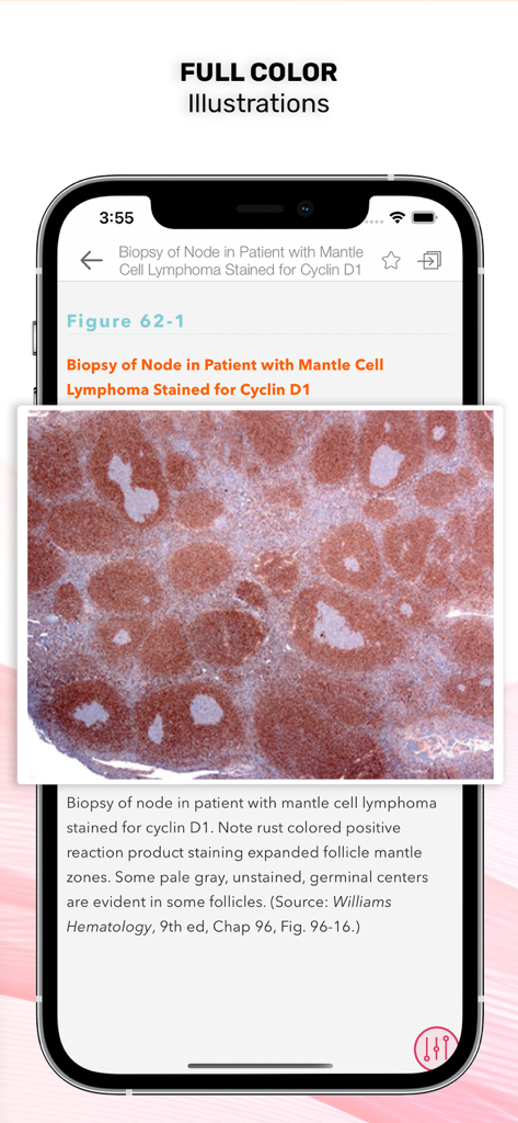 Williams Manual of Hematology - Full-color clinical illustration of a mantle cell lymphoma biopsy slide within the Williams Manual of Hematology app interface.