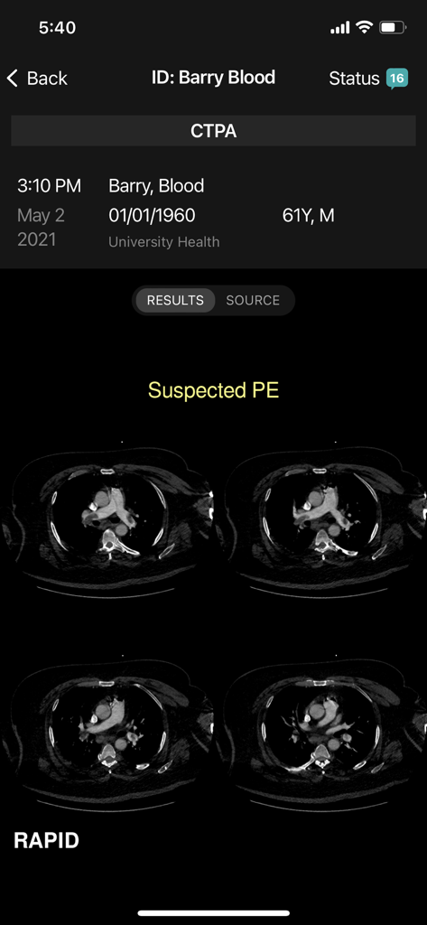 RapidAI mobile interface showing CTPA imaging results for a suspected pulmonary embolism case