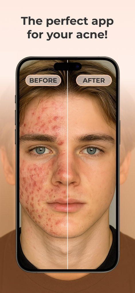 AcneTrack – Your Acne Journey - Confronto prima e dopo della pelle di un giovane uomo che mostra i risultati del trattamento dell'acne.