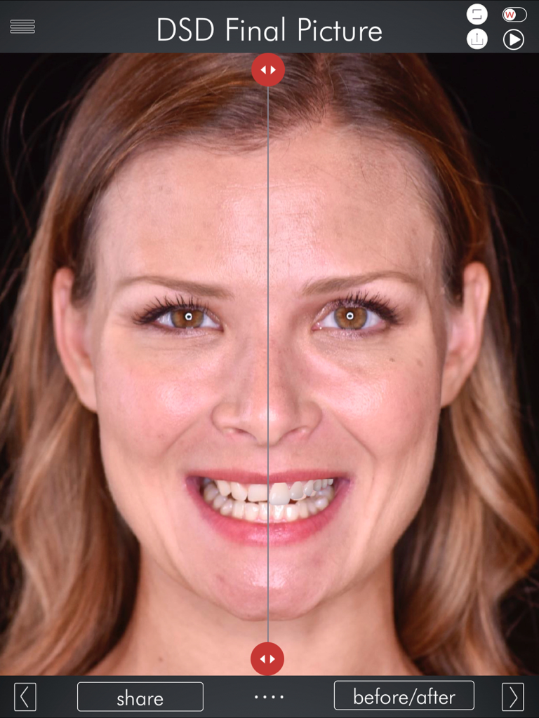 Comparación de pantalla dividida de antes y después de una simulación de diseño digital de sonrisa en el rostro de un paciente