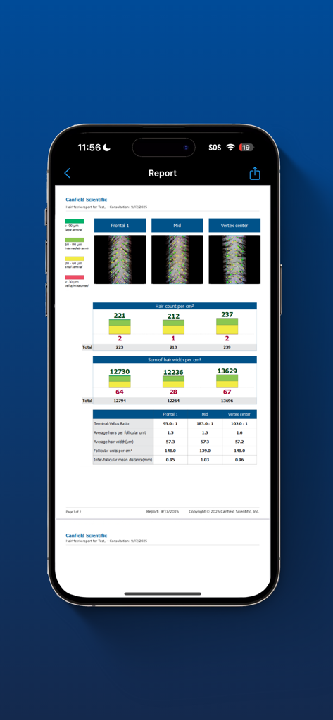 Professional hair analysis report in the VEOS HairMetrix app showing automated hair count and width metrics across different scalp areas.