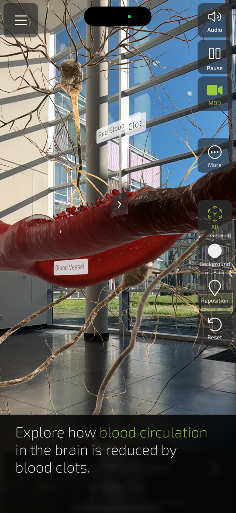 Augmented reality visualization of a blood clot in a brain vessel showing reduced circulation.