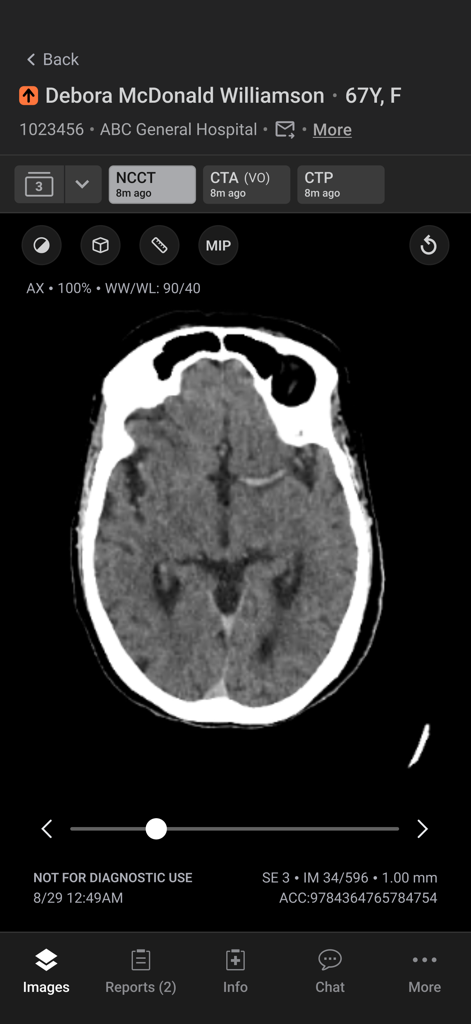 Aidoc - Aplicativo móvel Aidoc mostrando uma tomografia computadorizada do cérebro para avaliação médica