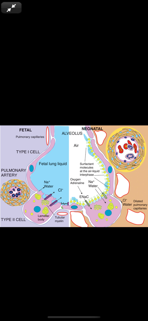 Rudolph's Pediatrics, 23/E - Medical illustration comparing the fetal and neonatal alveolus showing lung liquid transition and surfactant molecules