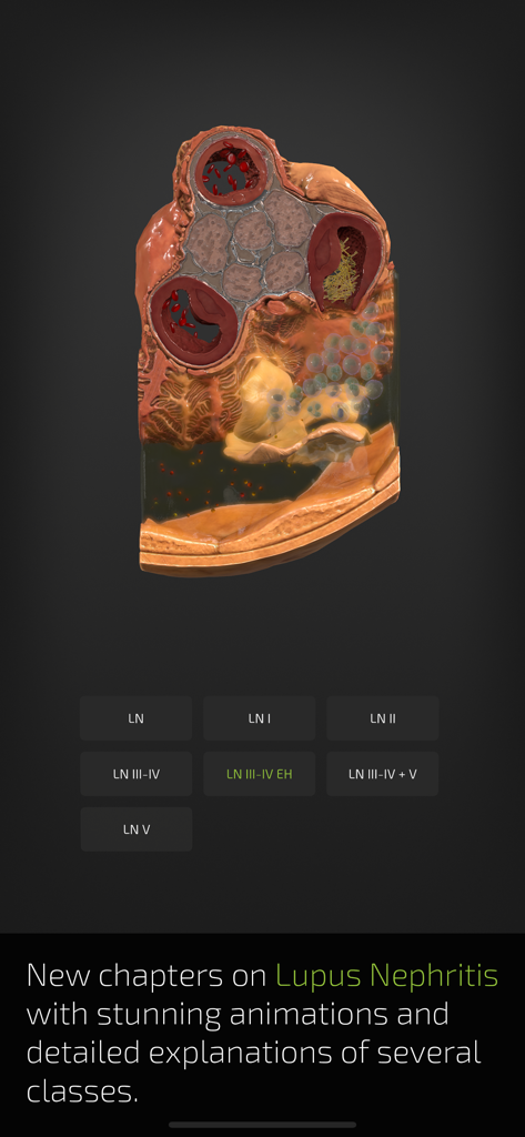 INSIGHT KIDNEY - A 3D anatomical cross-section of a kidney showing pathological changes associated with various classes of Lupus Nephritis.
