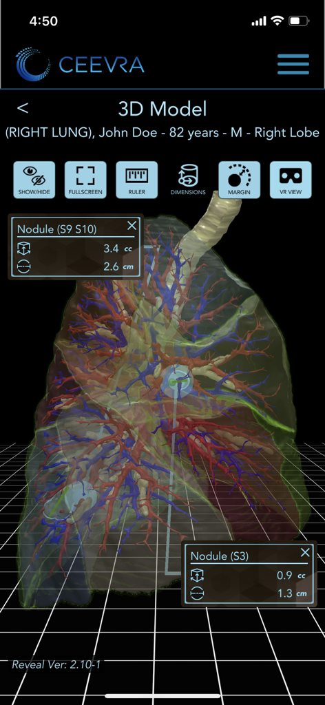 Ceevra - Ceevra app interface displaying a 3D lung model with surgical measurements and planning tools