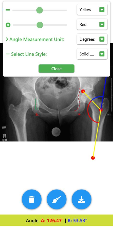 Angle Meter & Cobb Angle Meter - X-ray of a hip joint being measured with digital angle measurement tools in the Angle Meter app.