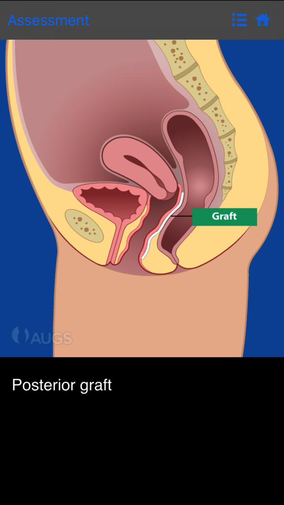 Anatomical illustration showing a posterior graft in the pelvic floor area