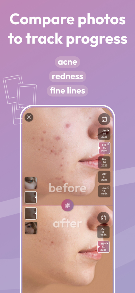 A mobile app interface displaying a before and after split-screen photo comparison tracking skin progress for acne and redness.