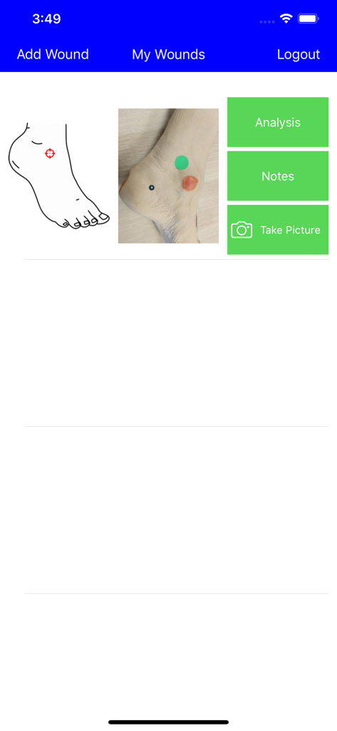 Mobile app interface displaying a foot wound entry with a diagram, photo, and buttons for analysis and notes