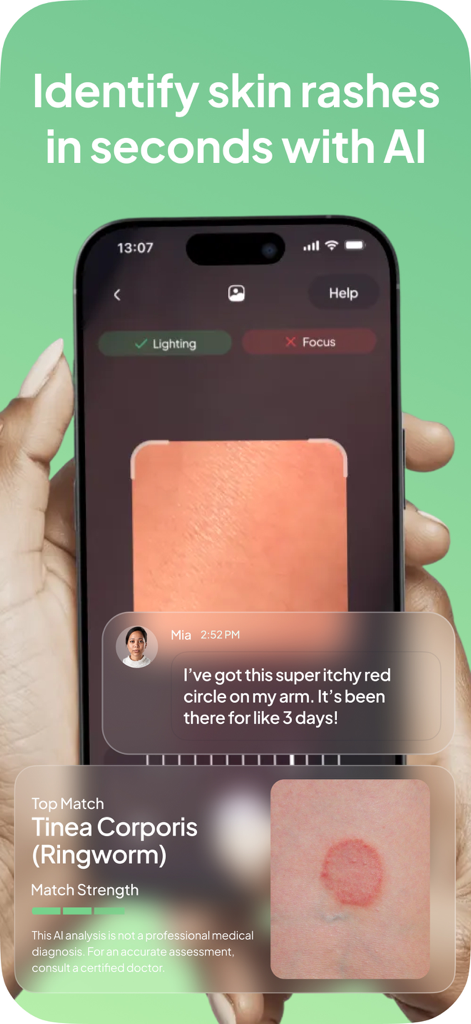 Smartphone screen showing the Rash ID app identifying a ringworm rash using AI analysis and user symptom description