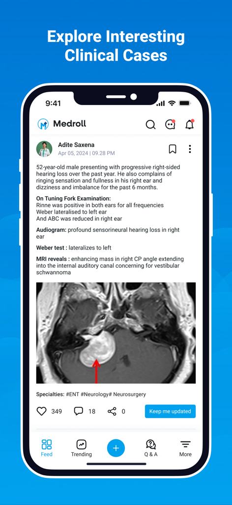 Medroll - Medical Network - A screenshot of the Medroll app displaying a clinical case post about a vestibular schwannoma with an MRI image and specialty tags.