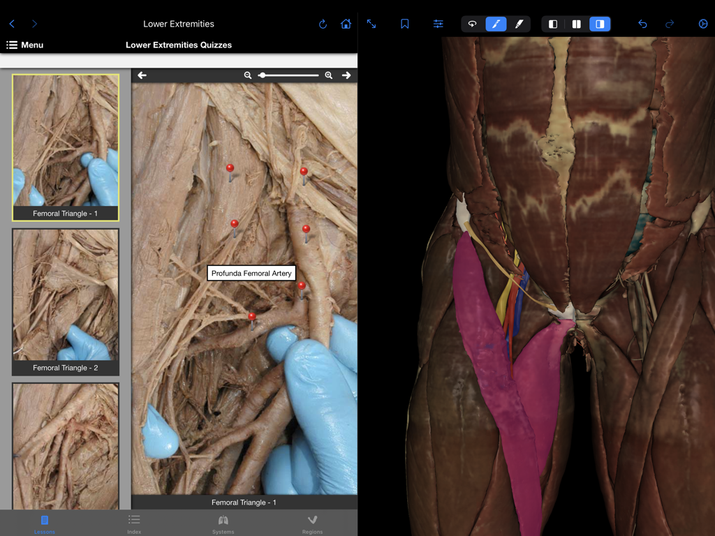 VH Dissector Pro - VH Dissector Pro interface displaying a cadaveric dissection quiz of the femoral triangle and a 3D anatomical muscle model