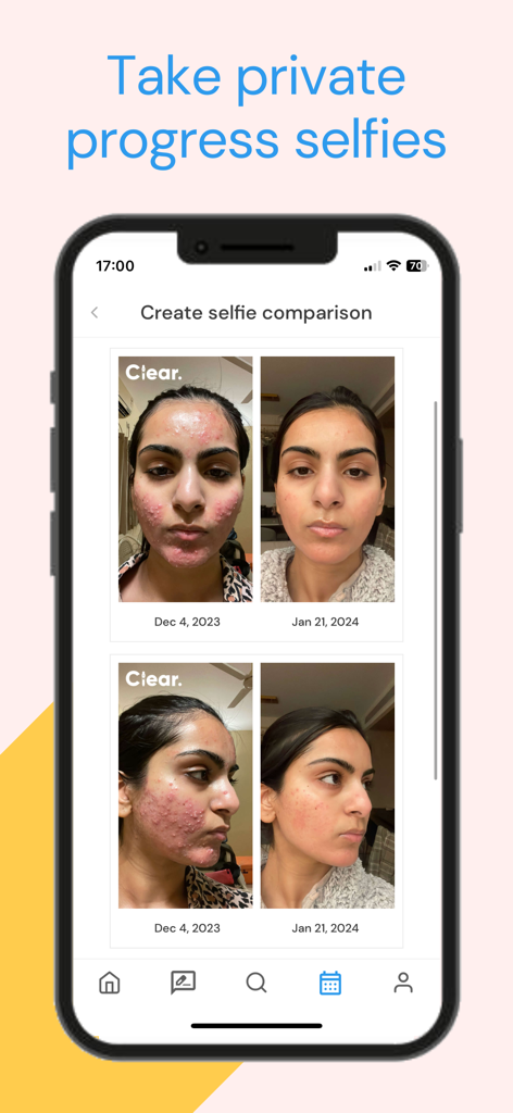 Comparaison de selfies de progrès de soins de la peau dans l'application Clear montrant les résultats avant et après
