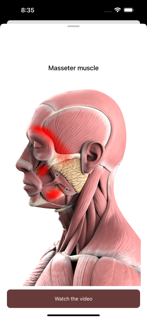 Trigger point - Body - Modelo anatómico 3D del músculo masetero con puntos gatillo y mapeo del dolor