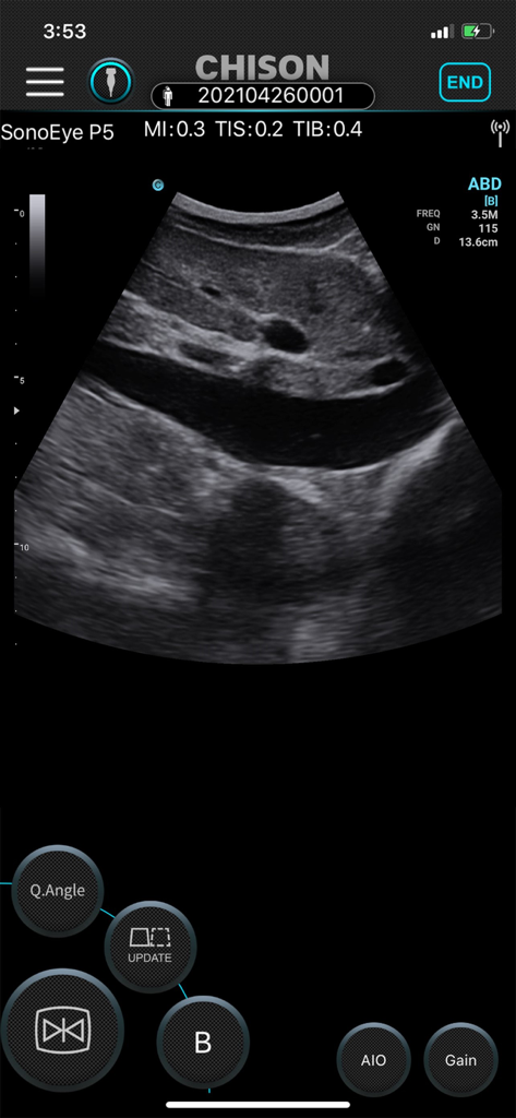 SonoEye - Interface do aplicativo móvel SonoEye exibindo um ultrassom abdominal ao vivo com controles de imagem diagnóstica