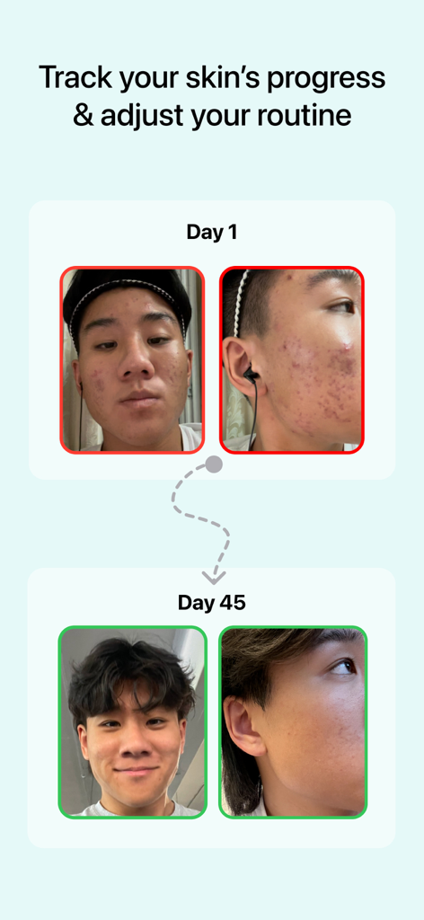 Glass: AI Skincare & Acne Scan - Before and after comparison of facial skin progress over 45 days using the Glass AI skincare app.