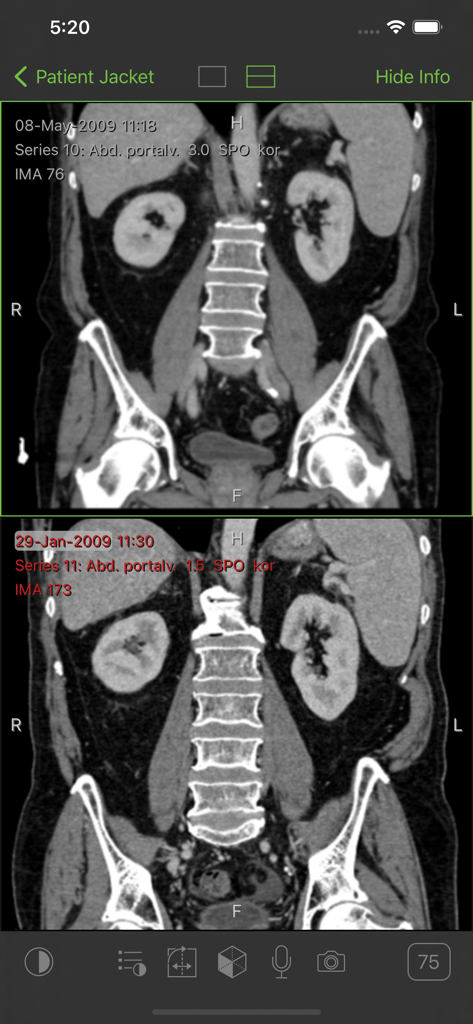 Visage Ease - Split screen view of patient abdominal CT scans in Visage Ease