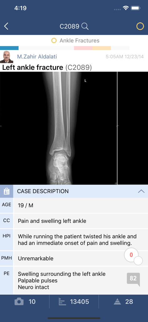 Bullets* - Clinical case study for a left ankle fracture in the Bullets app featuring an X-ray image and patient medical history