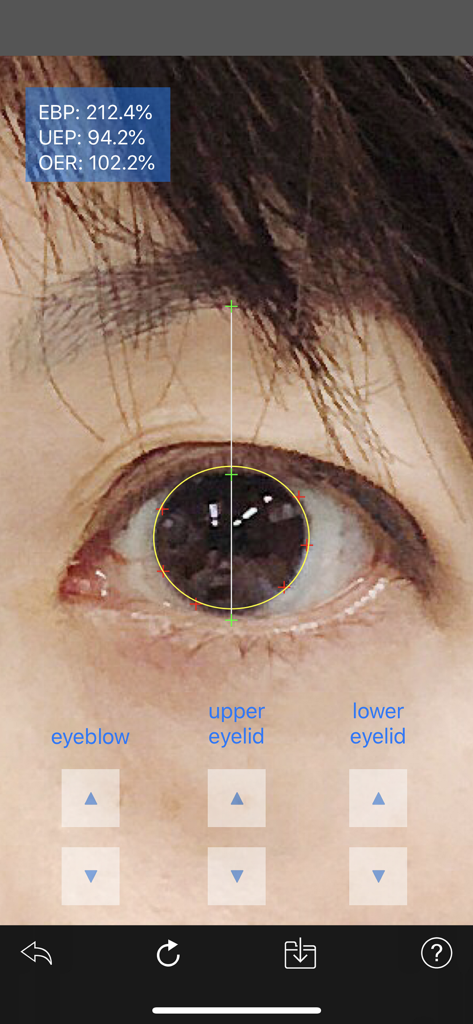Eyelid - A clinical interface of the Eyelid app showing eye opening ratio and position measurements on a human eye.