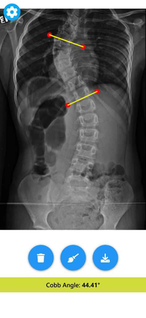 Angle Meter & Cobb Angle Meter - Scoliosis spine X-ray measurement showing a Cobb angle of 44.41 degrees in the app
