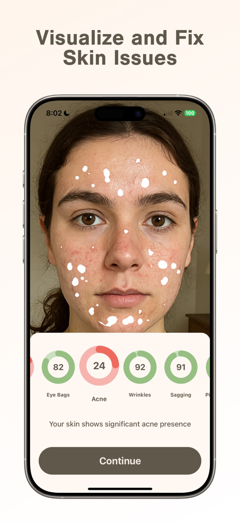Skan App-Bildschirm zeigt KI-Gesichtsscan und Hautanalyseergebnisse für Akne