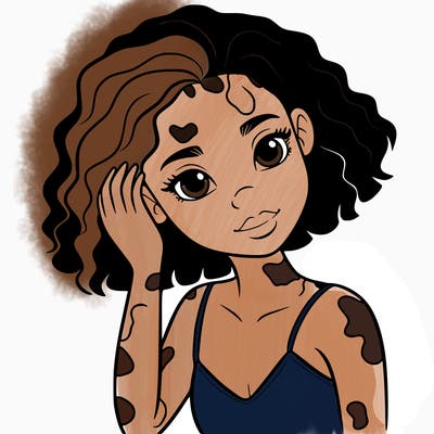 vitiligo black girl