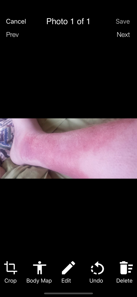 PACS Scan Mobile app interface showing a medical photo of a skin rash on a leg with editing tools like Crop and Body Map