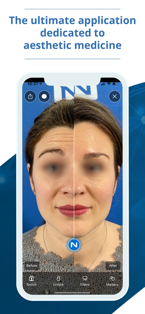 A split-screen view in the NM Capture app showing a patient's forehead before and after an aesthetic treatment.