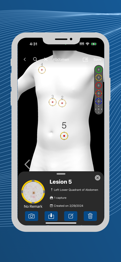 VEOS® DermaGraphix® - 皮膚科追跡のために、3D解剖学的ボディアバターにマッピングされた皮膚病変の位置を示す医療アプリのインターフェース。