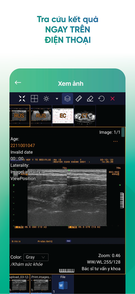 IVIE Bác sĩ ơi 의료 앱에서 초음파 결과를 보여주는 스마트폰 화면.