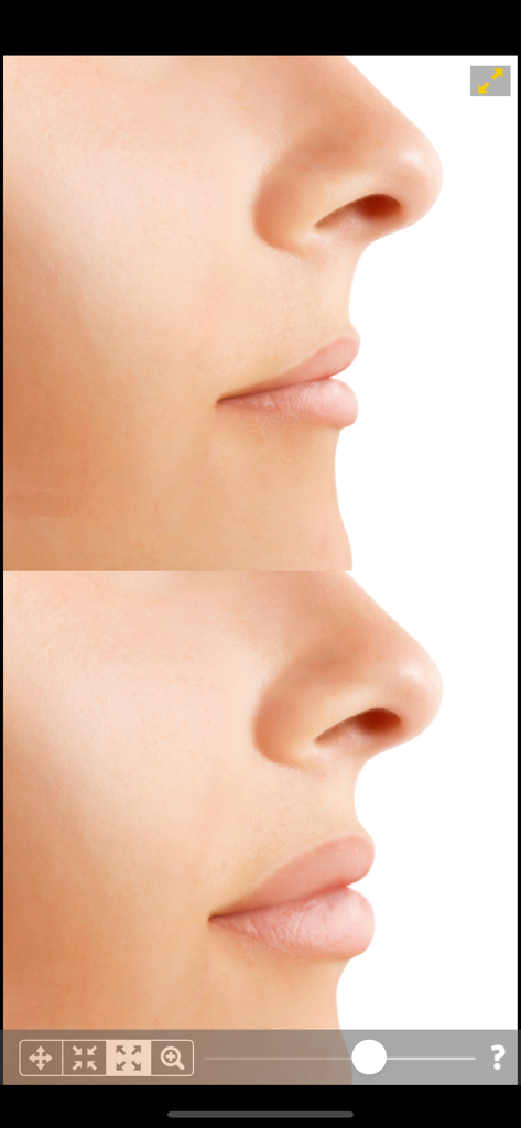 Confronto a schermo diviso di un profilo femminile prima e dopo il ritocco del naso e delle labbra