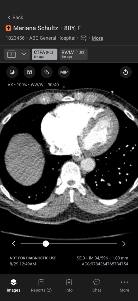 Aidoc - Interface do aplicativo móvel Aidoc exibindo uma tomografia computadorizada de angiografia pulmonar para revisão clínica de uma condição aguda