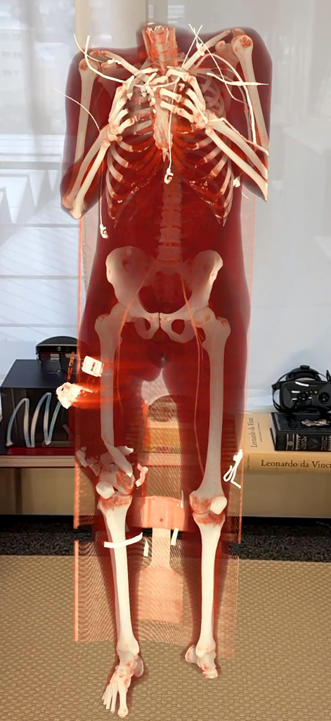 Medicalholodeck® - 医学教育および手術計画のための拡張現実3Dヒト骨格モデル