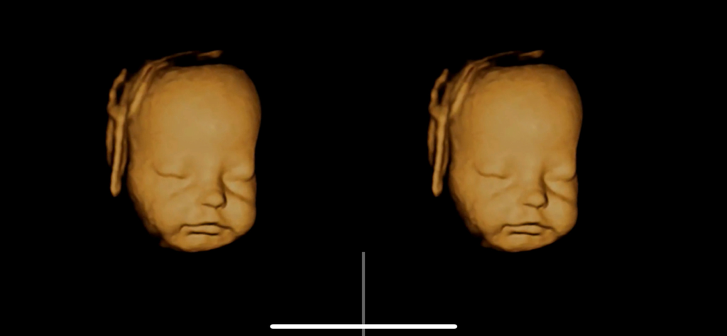 Aluvuu Fetus - Stereoscopic VR view of a 3D fetal ultrasound model face on a black background