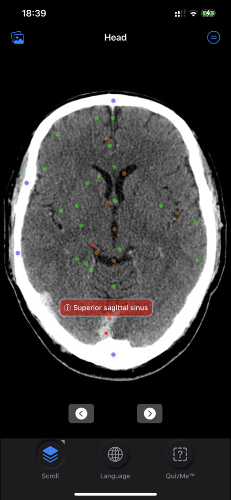 CT Anatomy - Axial head CT scan with color coded anatomical pins and superior sagittal sinus label in the CT Anatomy app