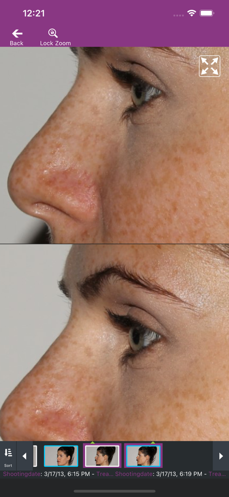 meesma - Professional skin imaging comparison in the meesma aesthetic app