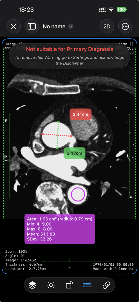Falcon Mx - Falcon Mx DICOM viewer displaying a CT scan with distance and area ROI measurement tools