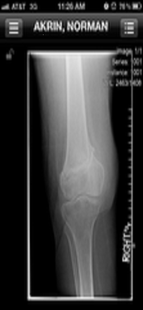 Synapse Mobility (Global) - Medical knee X-ray displayed in the Synapse Mobility mobile application