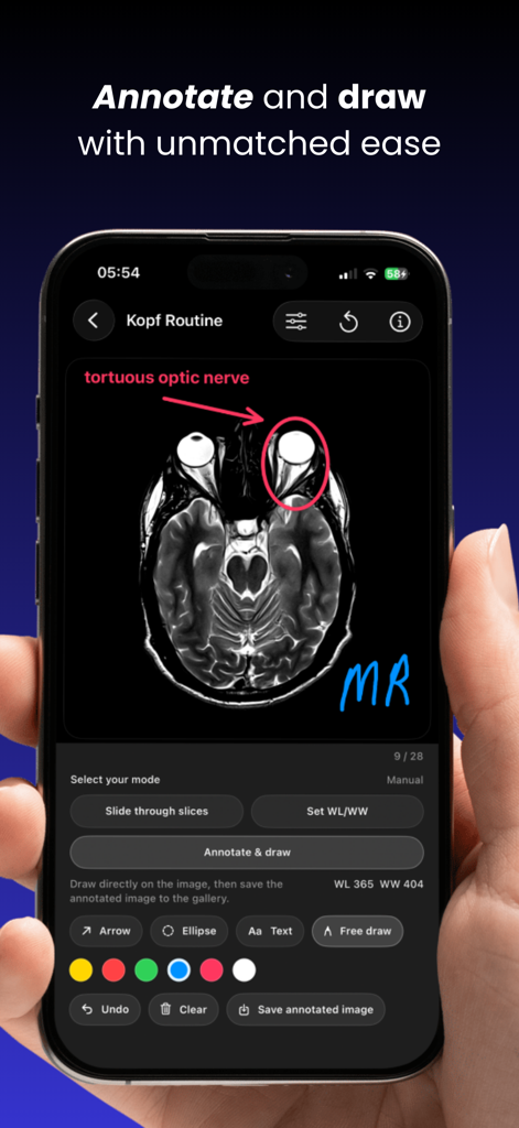 Dicom viewer MRI CT RX imaging - Pantalla de smartphone que muestra la anotación de imágenes médicas en una resonancia magnética usando flechas y etiquetas de texto.