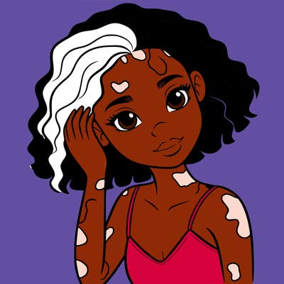 vitiligo black girl