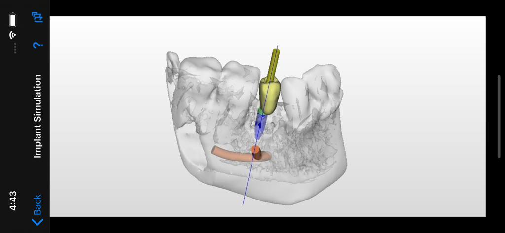 Dental CT View - 3D dental implant simulation showing tooth and jawbone