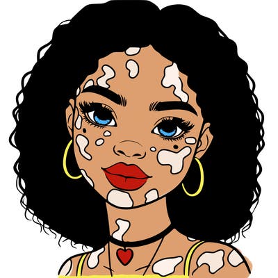 bleautiful black girl with vitiligo