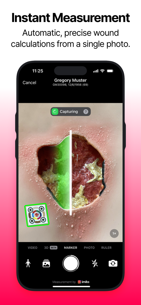 A smartphone screen displaying the WoundGenius app capturing an automatic and precise wound measurement from a single photo.