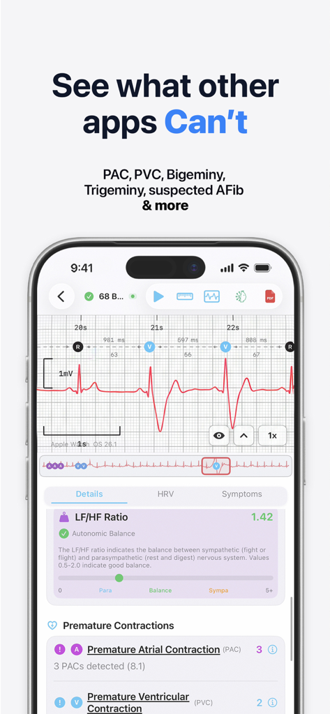 HeartLab app interface showing an ECG waveform with detailed analysis of premature atrial and ventricular contractions