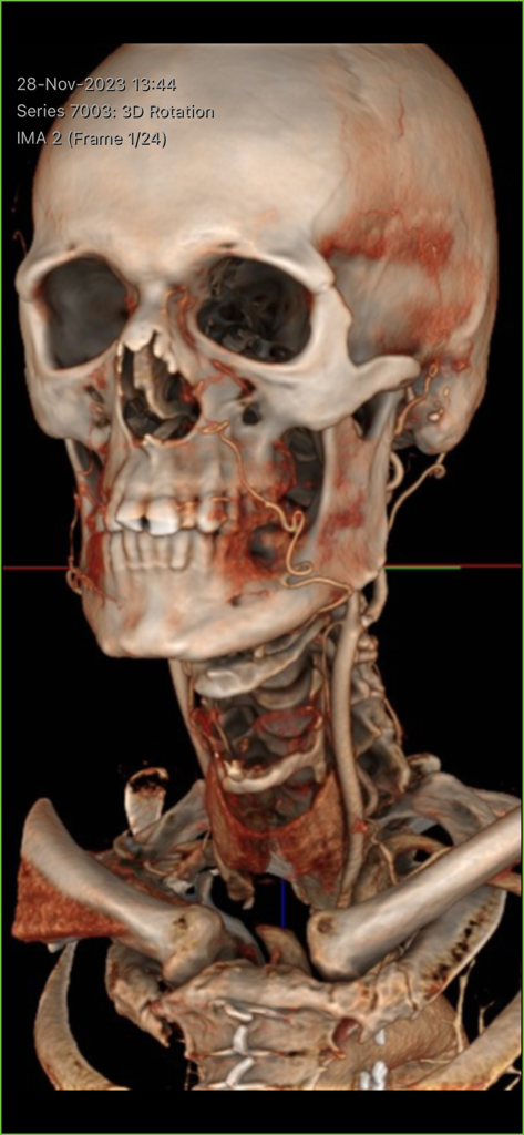 Visage Ease - 3D medical reconstruction of a human skull and neck vessels in the Visage Ease app