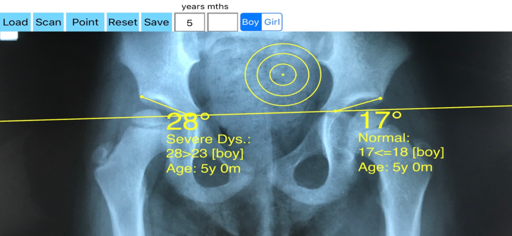 Digital measurement of acetabular index on a child pelvic X-ray showing diagnostic results for hip dysplasia.