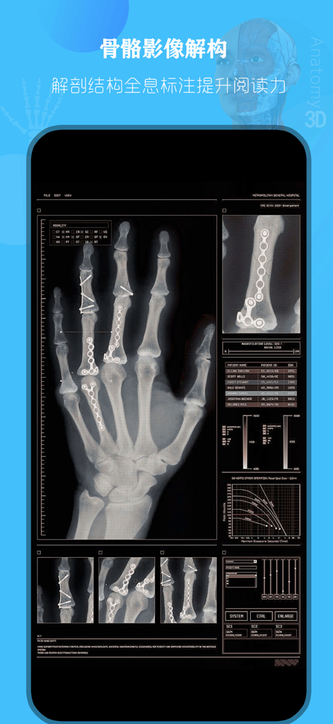 人体解剖学图谱 - 2025【专业版】 - Una radiografía de mano con placas y tornillos quirúrgicos mostrada dentro de la interfaz de la aplicación de anatomía médica para el estudio esquelético.