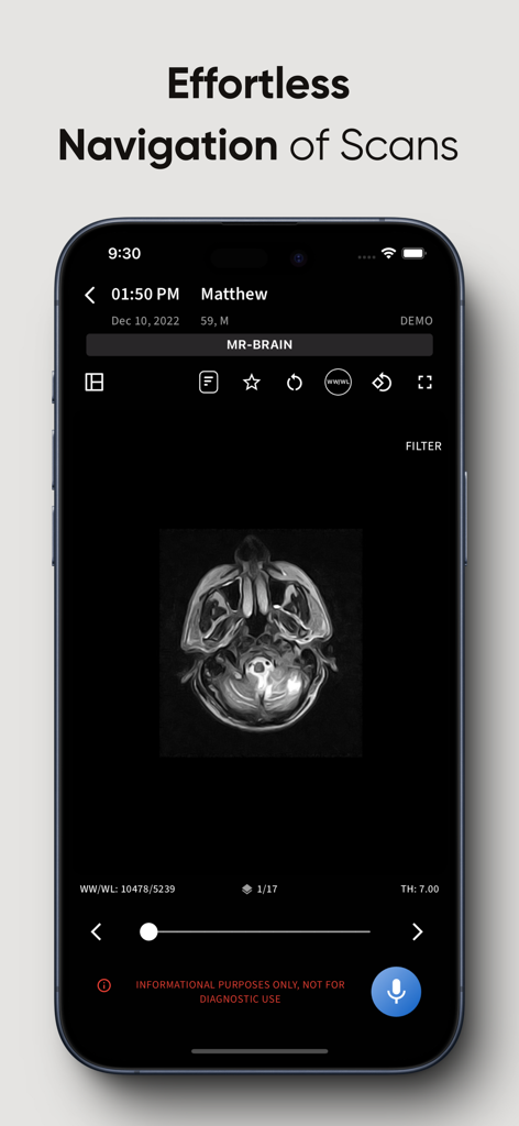 RadioView AI mobile interface displaying a detailed brain MRI scan