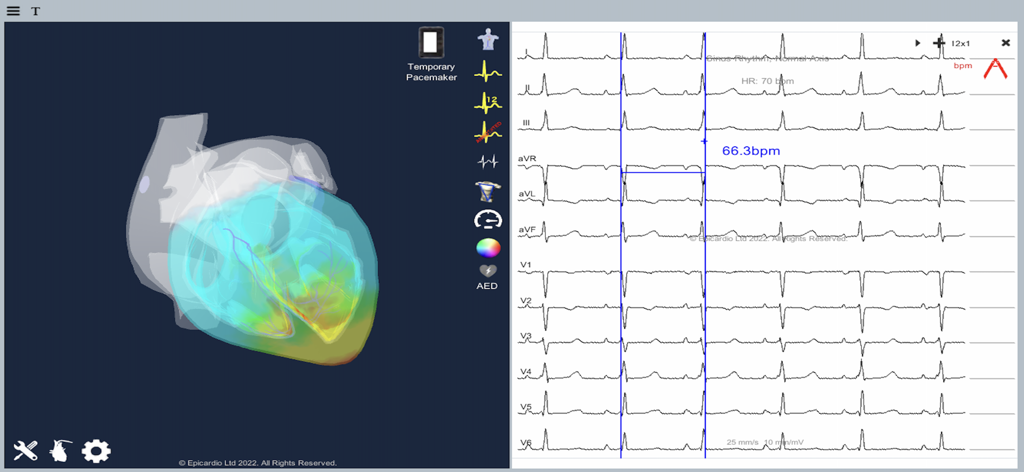 A 3D cardiac simulation showing the action potential wavefront alongside a 12-lead ECG display.